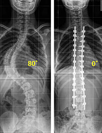NEW SPINAL X-RAYS