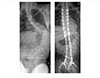 Correction of Scoliosis in Cerebral Palsy - 2
