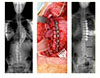 Scoliosis Correction through Anterior Approach - 1