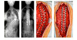 Scoliosis Correction through Posterior Approach - 1
