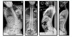 Syndromic Scoliosis - 2